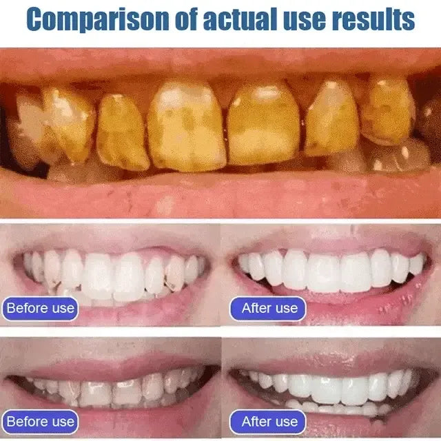 SP6 Advanced Teeth Whitening Toothpaste – 7 Days Instant Whitening ✨🦷